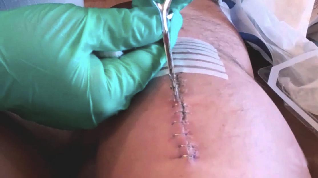 A surgeon removes staples in a knee post op